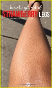 How to Get Rid of Strawberry Legs