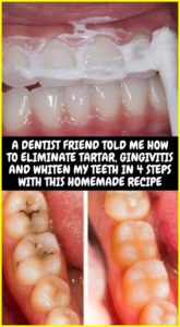 A DENTIST FRIEND TOLD ME HOW TO ELIMINATE TARTAR, GINGIVITIS AND WHITEN MY TEETH IN 4 STEPS WITH THIS HOMEMADE RECIPE