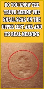 Do You Know The Truth Behind The Small Scar On The Upper Left Arm And Its Real Meaning