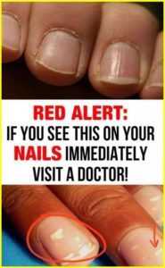 Red Alert: If You See This On Your Nails Immediately Visit A Doctor!