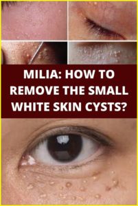 MILIA: HOW TO REMOVE THE SMALL WHITE SKIN CYSTS?