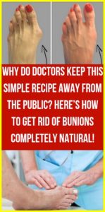 WHY DO DOCTORS KEEP THIS SIMPLE RECIPE AWAY FROM THE PUBLIC? HERE’S HOW TO GET RID OF BUNIONS COMPLETELY NATURAL HEALTH