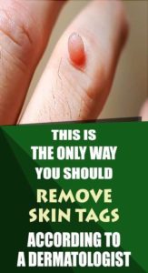 How to Remove Skin Tag in 1 Night